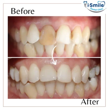 Teeth Whitening Clinic Goa