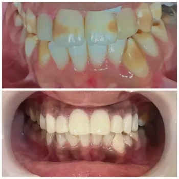 Teeth Whitening in Goa