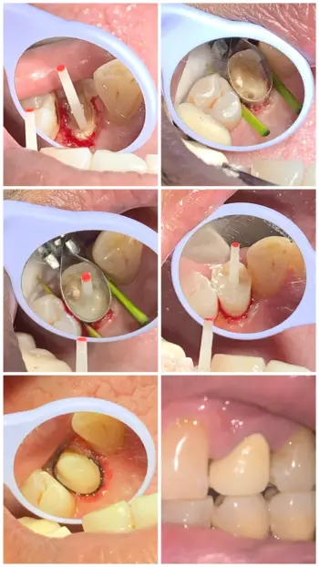 Teeth Whitening in Goa
