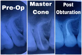 Teeth Whitening in Goa