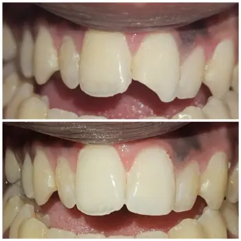 Teeth Whitening in Goa