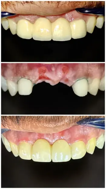 Teeth Whitening in Goa