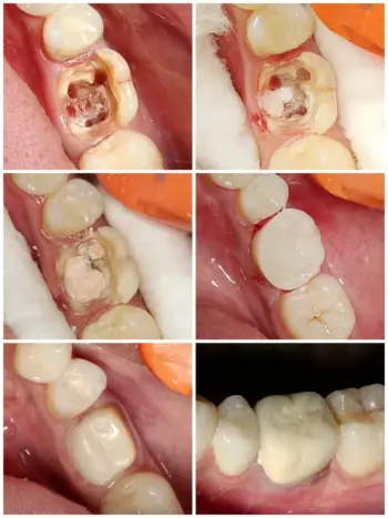 Teeth Whitening in Goa