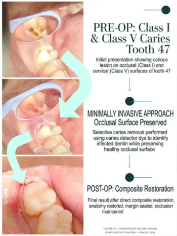 Teeth Whitening in Goa